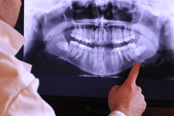 Best Emergency Wisdom Teeth Removal in Hillburn, NY